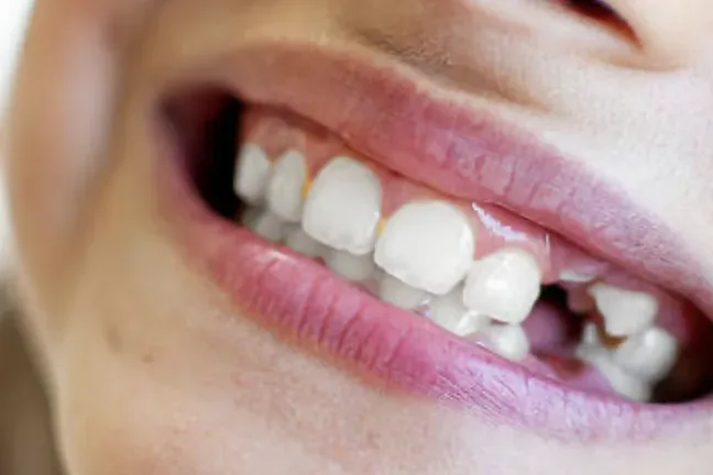 Broken Tooth Repair in Louisville, KY