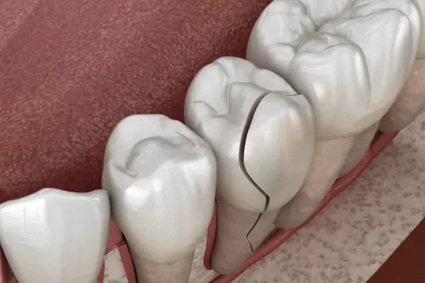 Cracked Tooth Repair in Louisville, KY