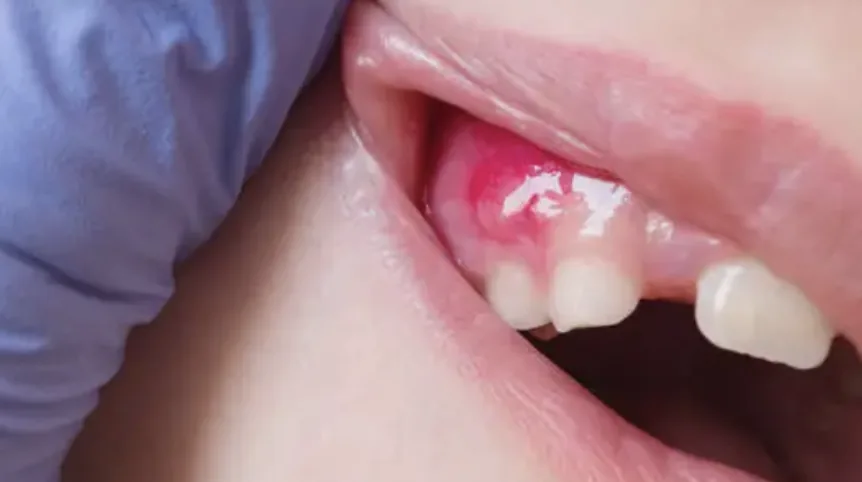 Dental Abscess Treatment in Louisville, KY