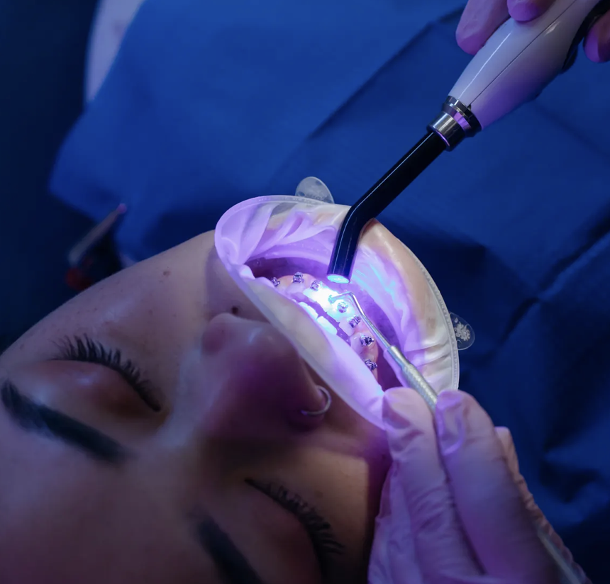 In-office teeth whitening treatment for a patient in Louisville, KY