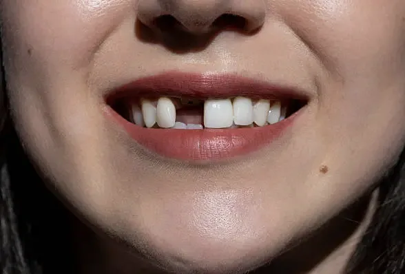 Replacing Missing Teeth in Louisville, KY